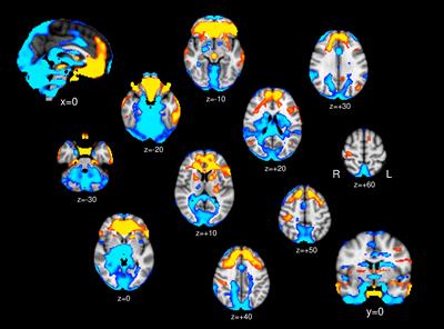 Pituitary Gland Functional Connectivity and BMI